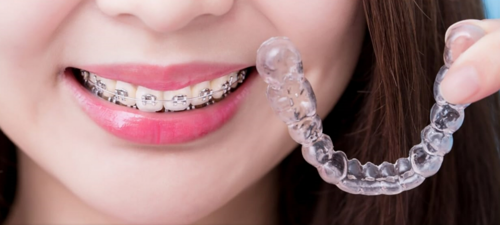 Clear aligners1